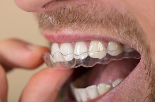 Achieving Your Desired Smile: Invisalign's Impact on Oral Health