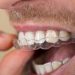 Achieving Your Desired Smile: Invisalign's Impact on Oral Health