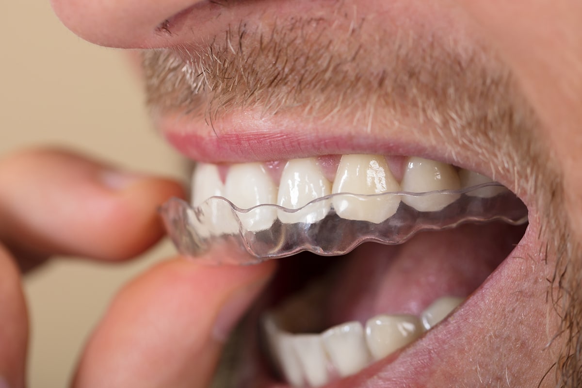 Achieving Your Desired Smile: Invisalign's Impact on Oral Health