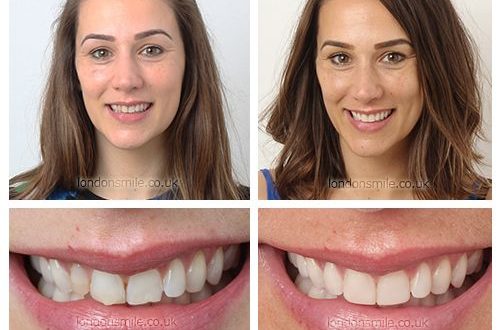 Personalising Your Smile: Revolutionary Techniques in Composite Bonding