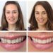 Personalising Your Smile: Revolutionary Techniques in Composite Bonding