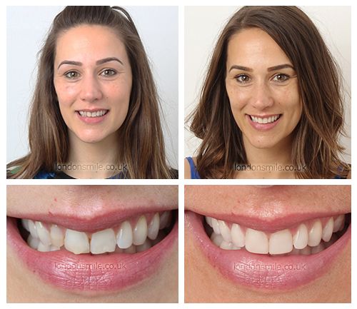 Personalising Your Smile: Revolutionary Techniques in Composite Bonding