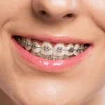 Unlocking the Secrets of Braces: A Journey to Personal Transformation