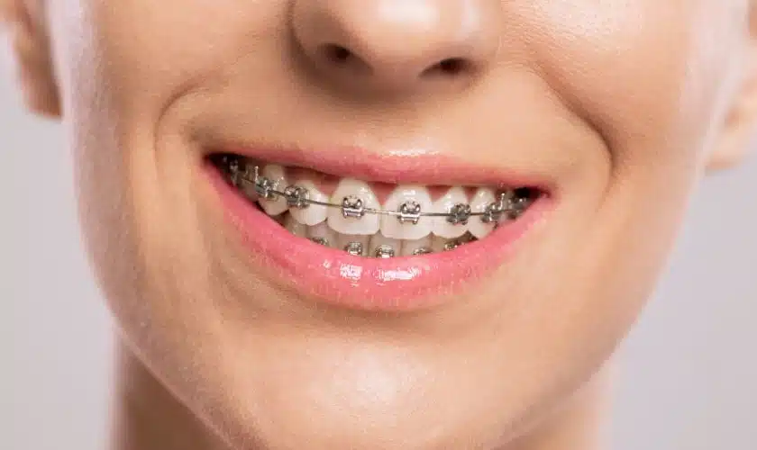 Unlocking the Secrets of Braces: A Journey to Personal Transformation