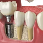 Innovative Approaches to Enhancing Dental Implant Biocompatibility