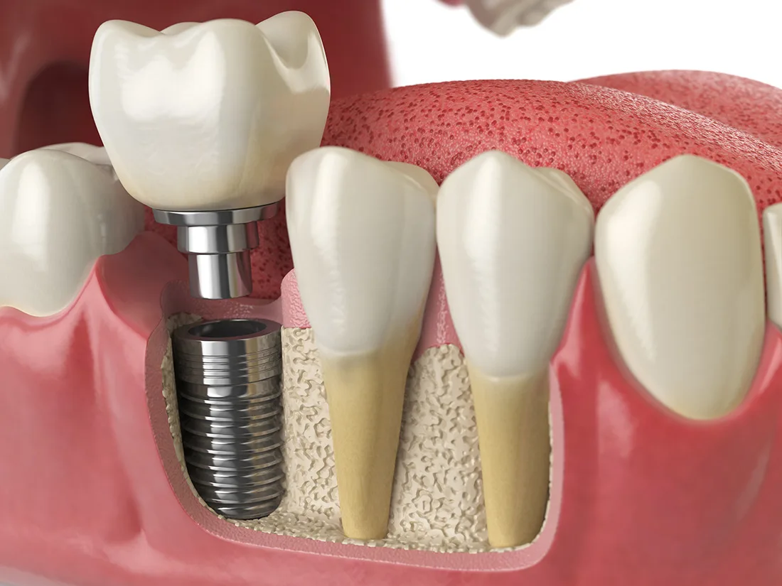 Innovative Approaches to Enhancing Dental Implant Biocompatibility