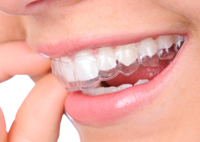 Invisalign: The Hidden Benefits of Clear Aligners for Busy Professionals